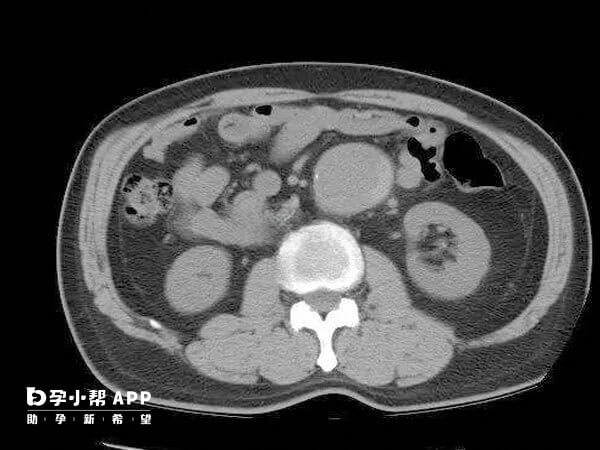 经腹的手术过程较复杂
