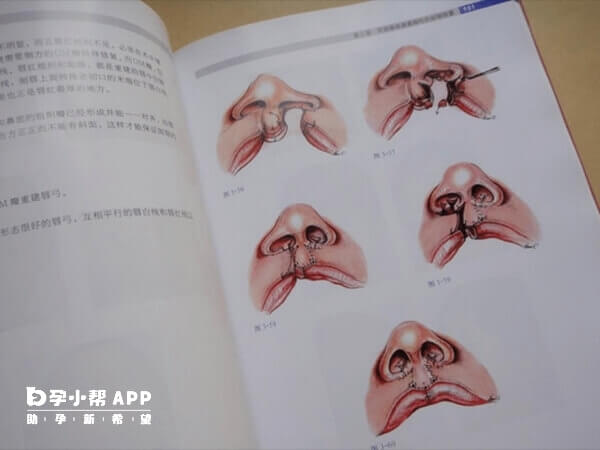 免唇腭裂是一种多基因遗传性疾病