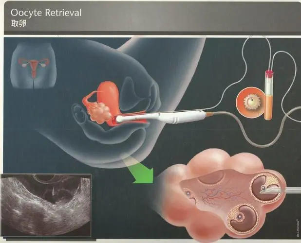 做试管取卵过程