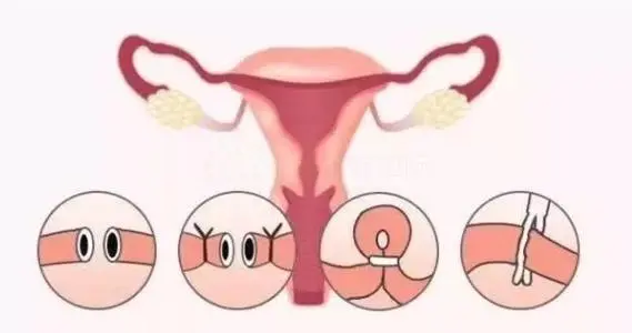 卵巢堵塞可以做试管吗