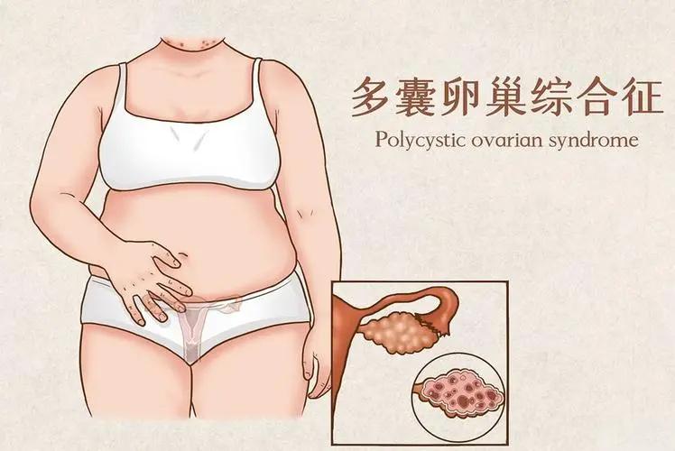 多囊卵巢能怀上孩子吗