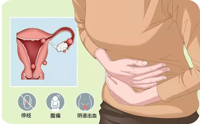 宫外孕的八个症状