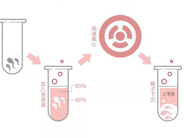 HIV洗精要多少钱