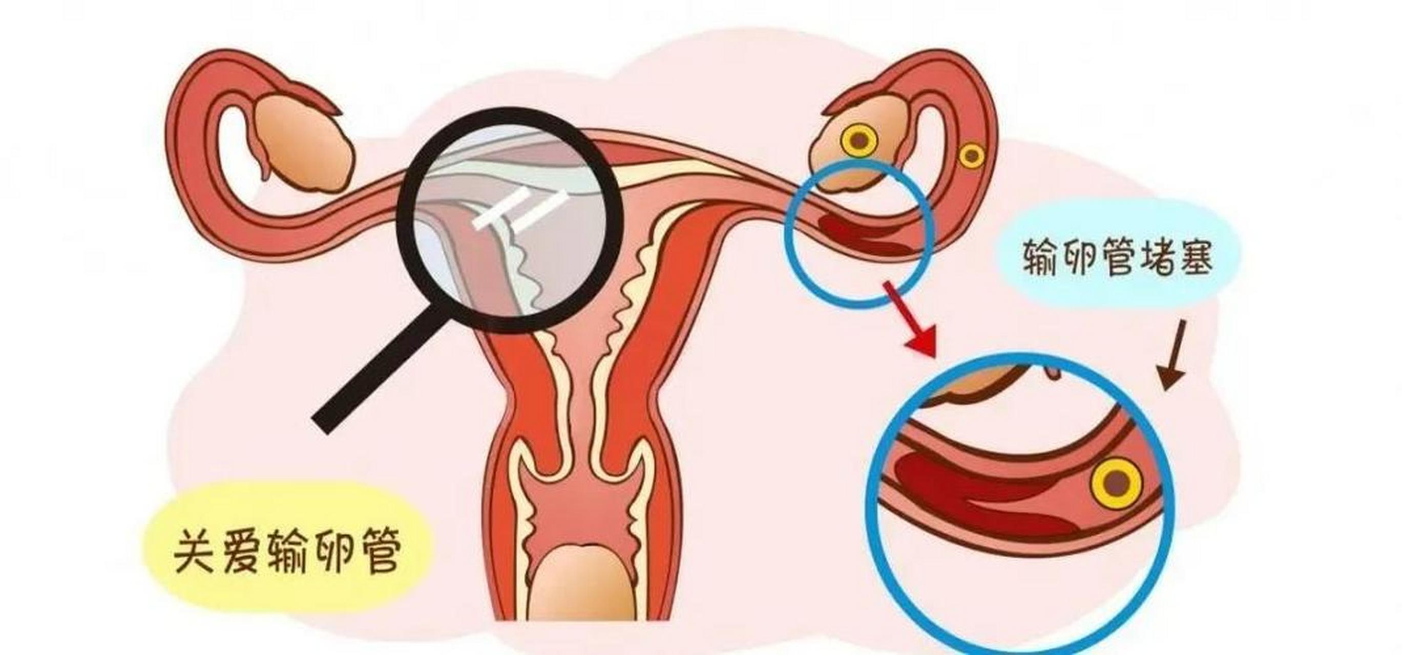 输卵管堵塞的10个征兆