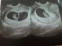 听说孕囊形状可以看出生男生女这是真的吗