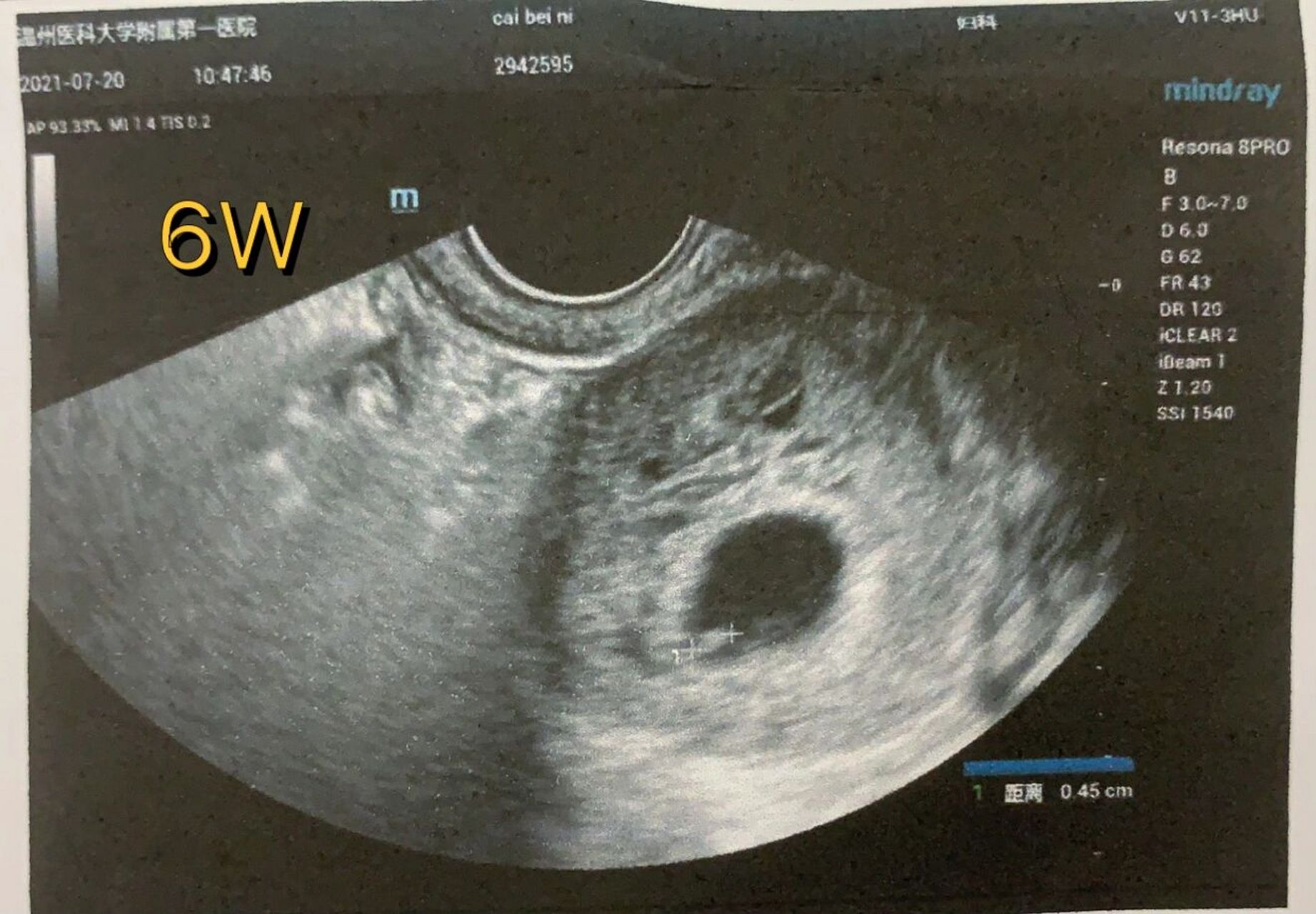 超级准确的孕囊大小看男女99%准确对照表在线一览