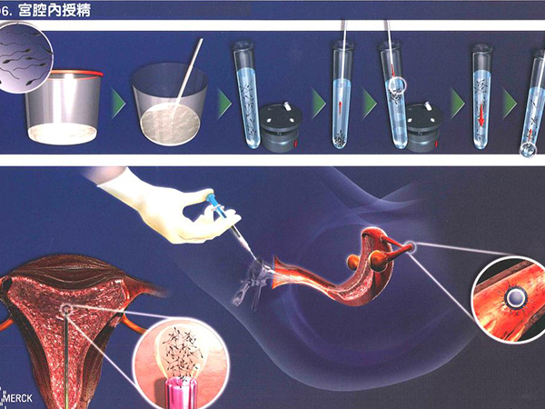 仅需一文即可帮助你轻松了解人工授精的六种方法