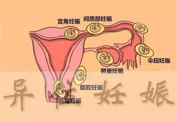 女性必看：四种引起宫外孕的高发原因你需要注意