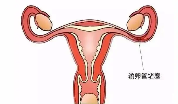 输卵管堵塞是什么原因造成的-影响怀孕吗--附最佳治疗效果