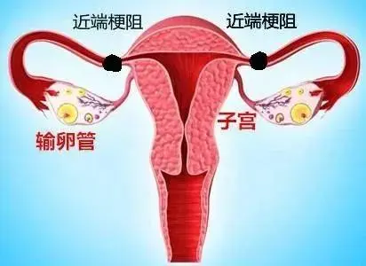 输卵管堵塞是什么原因造成的-影响怀孕吗--附最佳治疗效果
