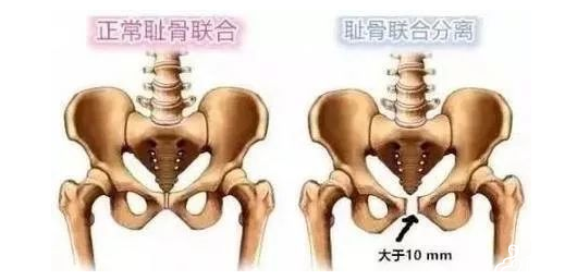 在孕期间孕妇为什么耻骨会痛？附图片讲解