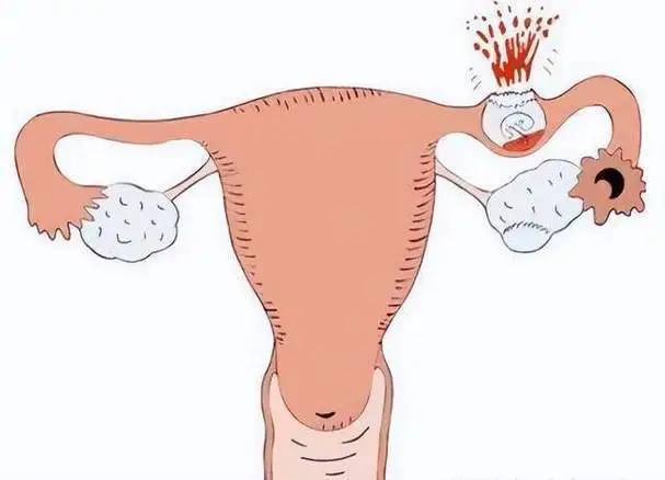 宫外孕早期身体发出这六大信号，如有建议及早就医