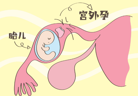 宫外孕早期身体发出这六大信号，如有建议及早就医