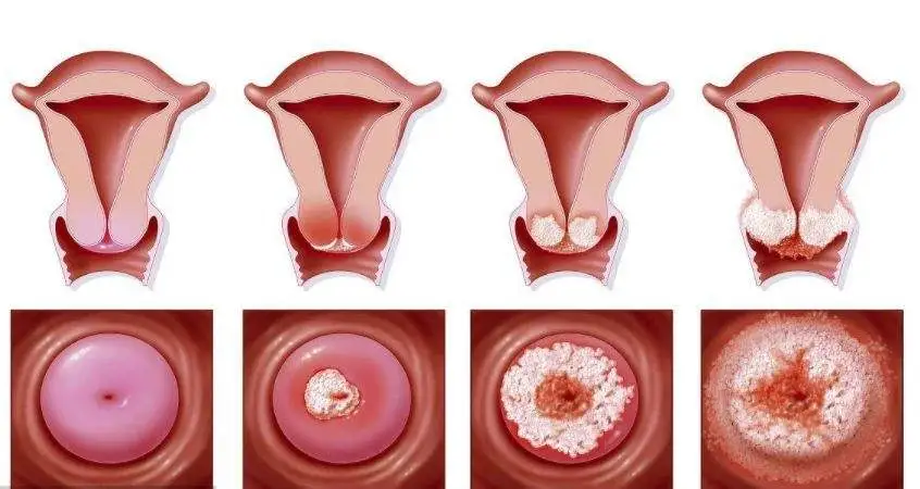 这7种女人易患上宫颈癌并且还是高危人群