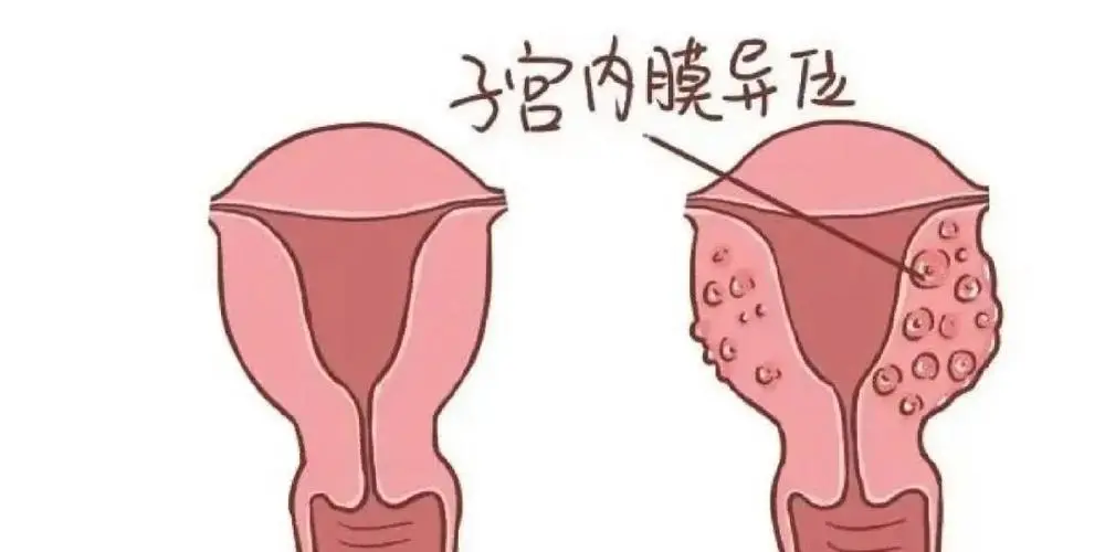 女性同房后有少量出血原因解析：这几个原因引发几率很大