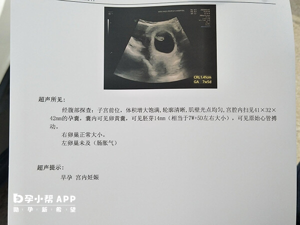 胎停育的超声检查结果常表现为枯萎卵