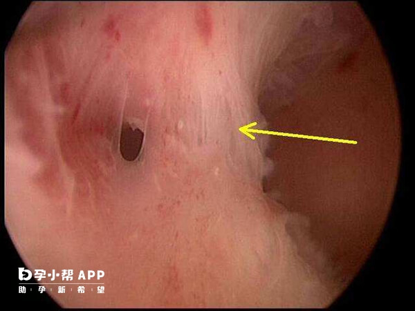 宫腔粘连封闭了一部分宫腔