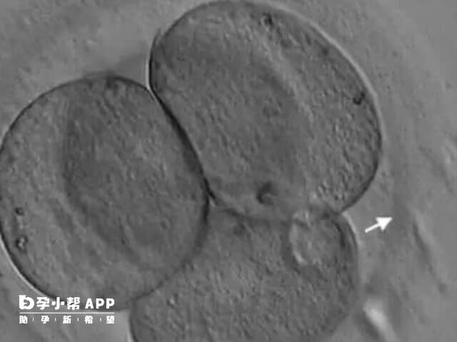 人体胚胎孵化旨在优化胚胎着床条件