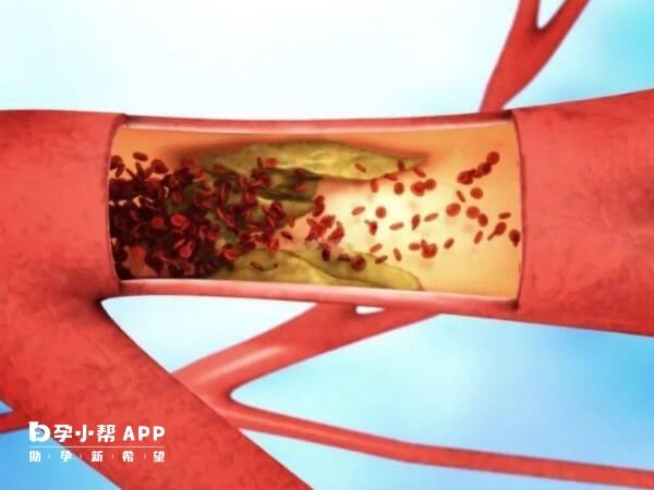 血栓是指血流在血管内创面所形成的小块