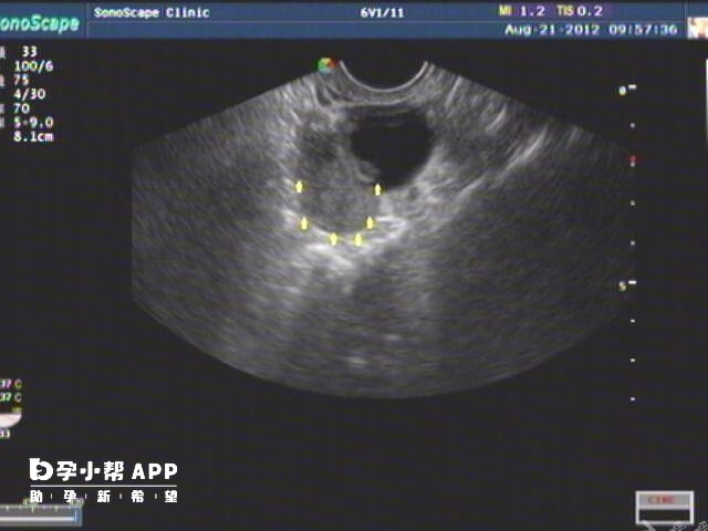 短方案一般在月经第2天开始使用GnRH-a