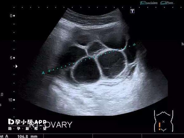 卵巢过度刺激综合征可能引起尿多情况