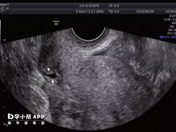 试管移植后出现胸腔积液会影响身体状态