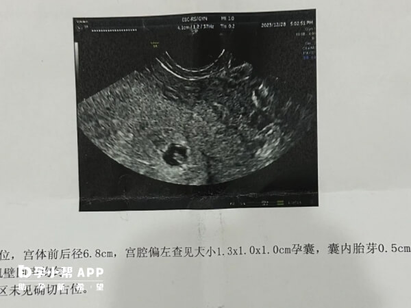 胎停可能是胚胎自身缺陷导致的自然淘汰