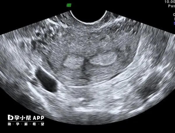 摘除子宫不能通过自然方式妊娠