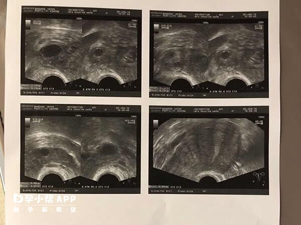 短方案用药时间短