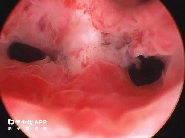 定期进行妇科检查预防宫腔粘连