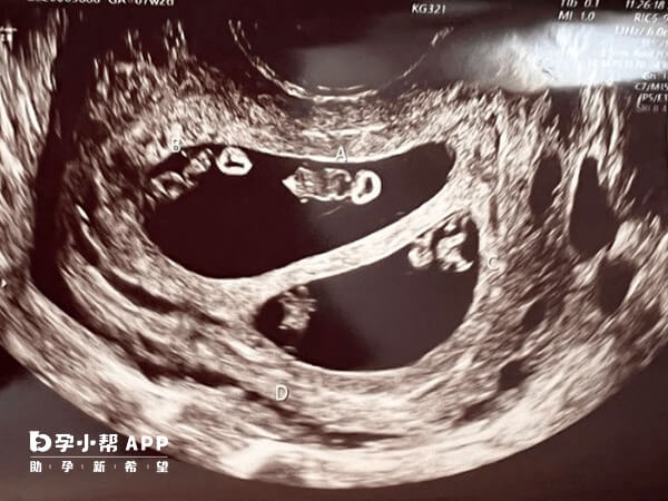 试管婴儿技术实现龙凤胎需要满足一定条件