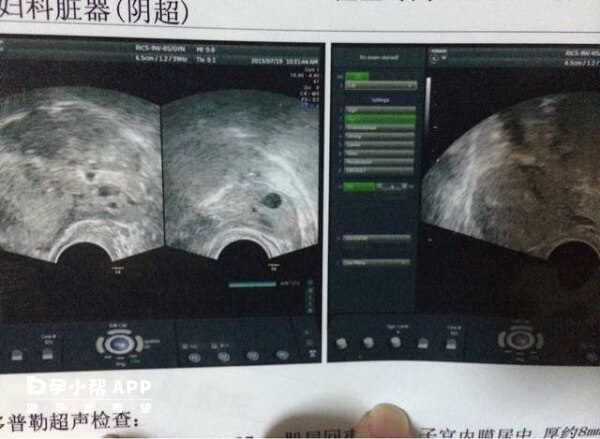 宫寒可能导致子宫内血液循环不畅