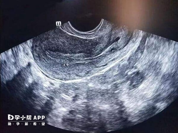 子宫切除术是指通过阴道或腹部切口实施的