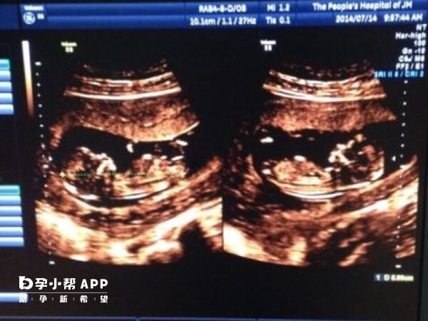 双胞胎大排畸畸形严重可考虑选择性减胎