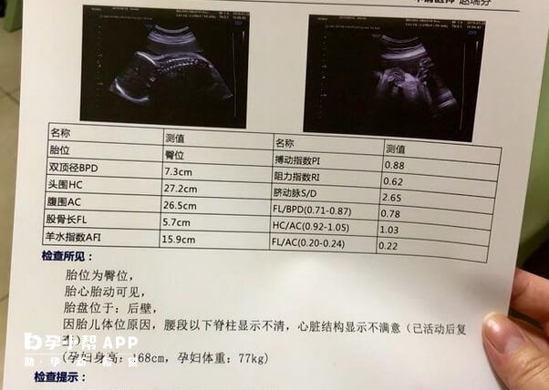 双胞胎小排畸一般在孕28-32周做最合适
