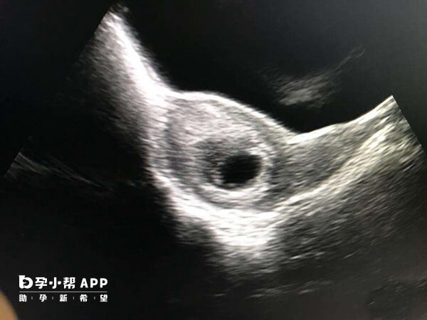 发生在孕早期的胚胎发育异常现象称为胚胎停育