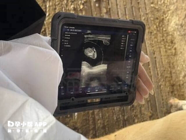 B超监测排卵需要多次往返医院