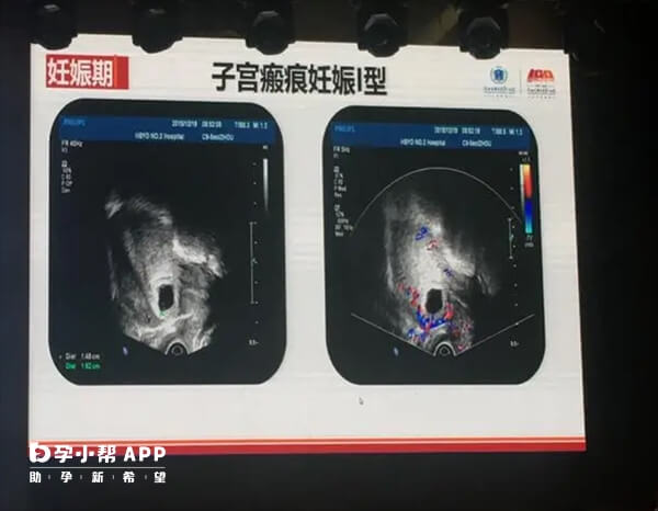 瘢痕子宫患者建议优先选择单胚胎移植
