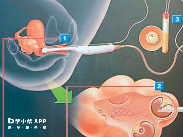 单腔取卵针操作相对简单