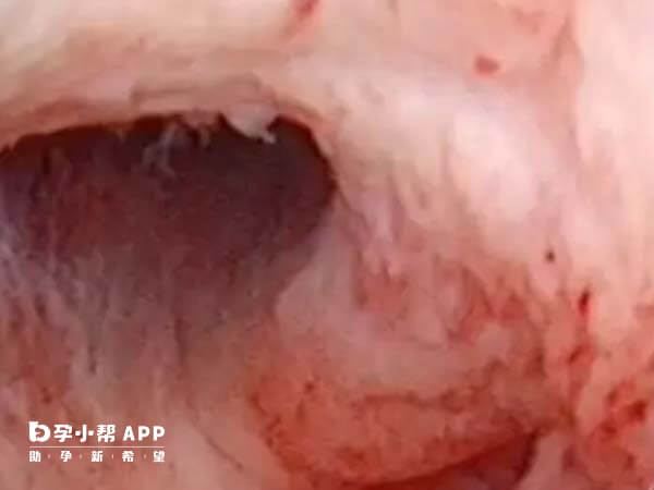 宫腔粘连与人流次数无关