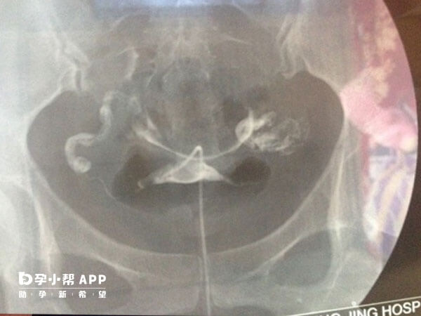 输卵管增粗可能引起轻度炎症或粘连