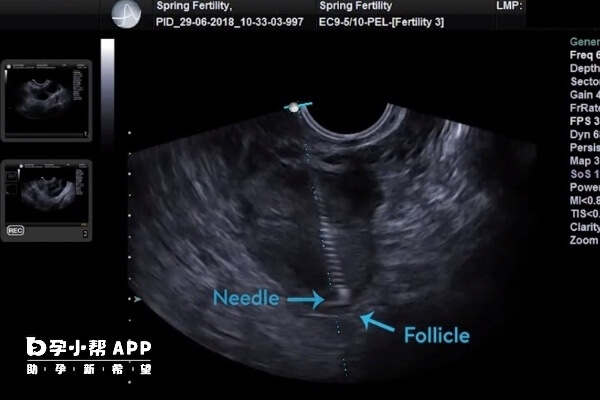取卵后一周以内会发生腹水
