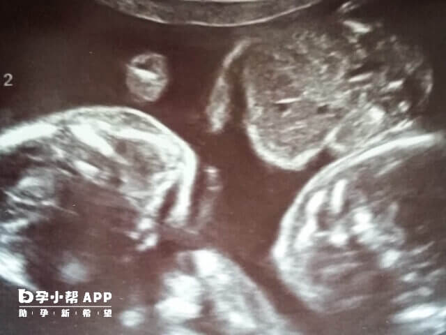 自然怀双胎的几率很小