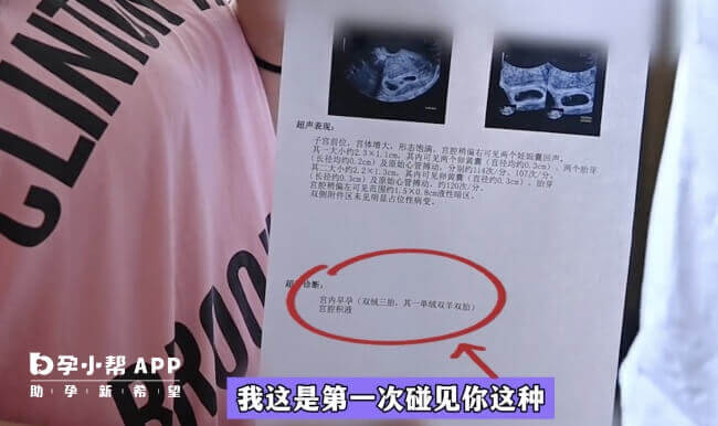 山东菏泽女子怀上同卵异卵三胞胎