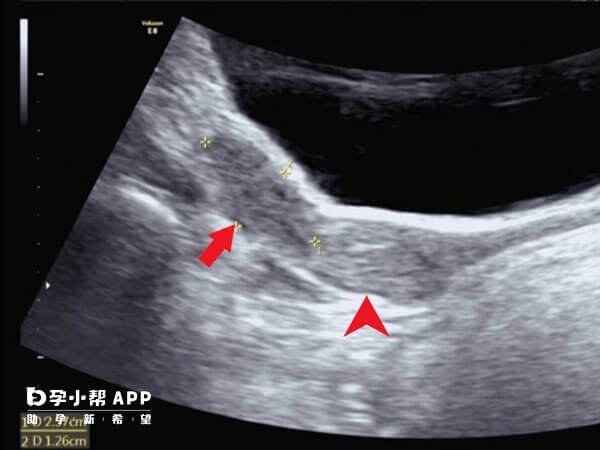 幼稚子宫要及时治疗