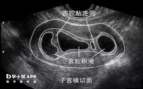 多次人工流产或者刮宫导致宫腔粘连