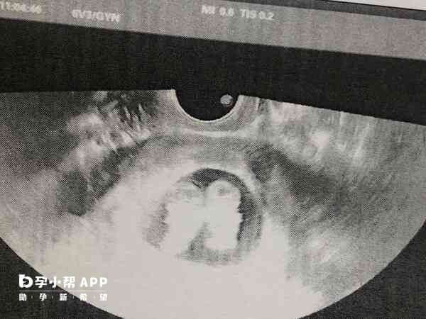 输卵管结扎仅阻断了自然受孕的通道