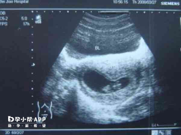 B超检查要在月经干净后3~7天内进行