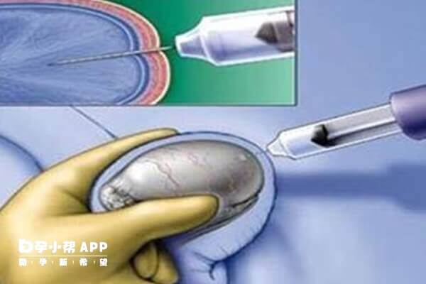做二代试管不一定都要穿刺取精
