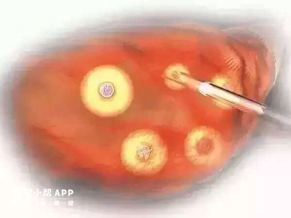 一些女性取卵后会出现腹水
